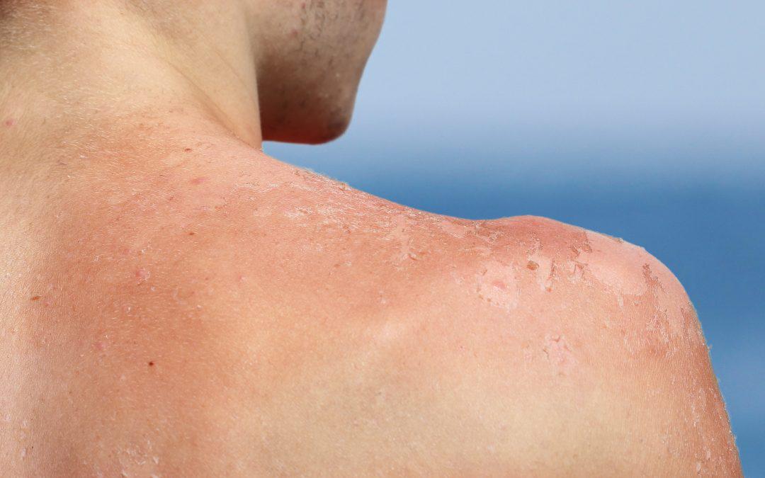 Understanding Sun Poisoning: Symptoms, Risks, and Prevention