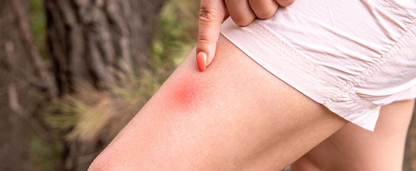 Woman pointing tick bites on her leg