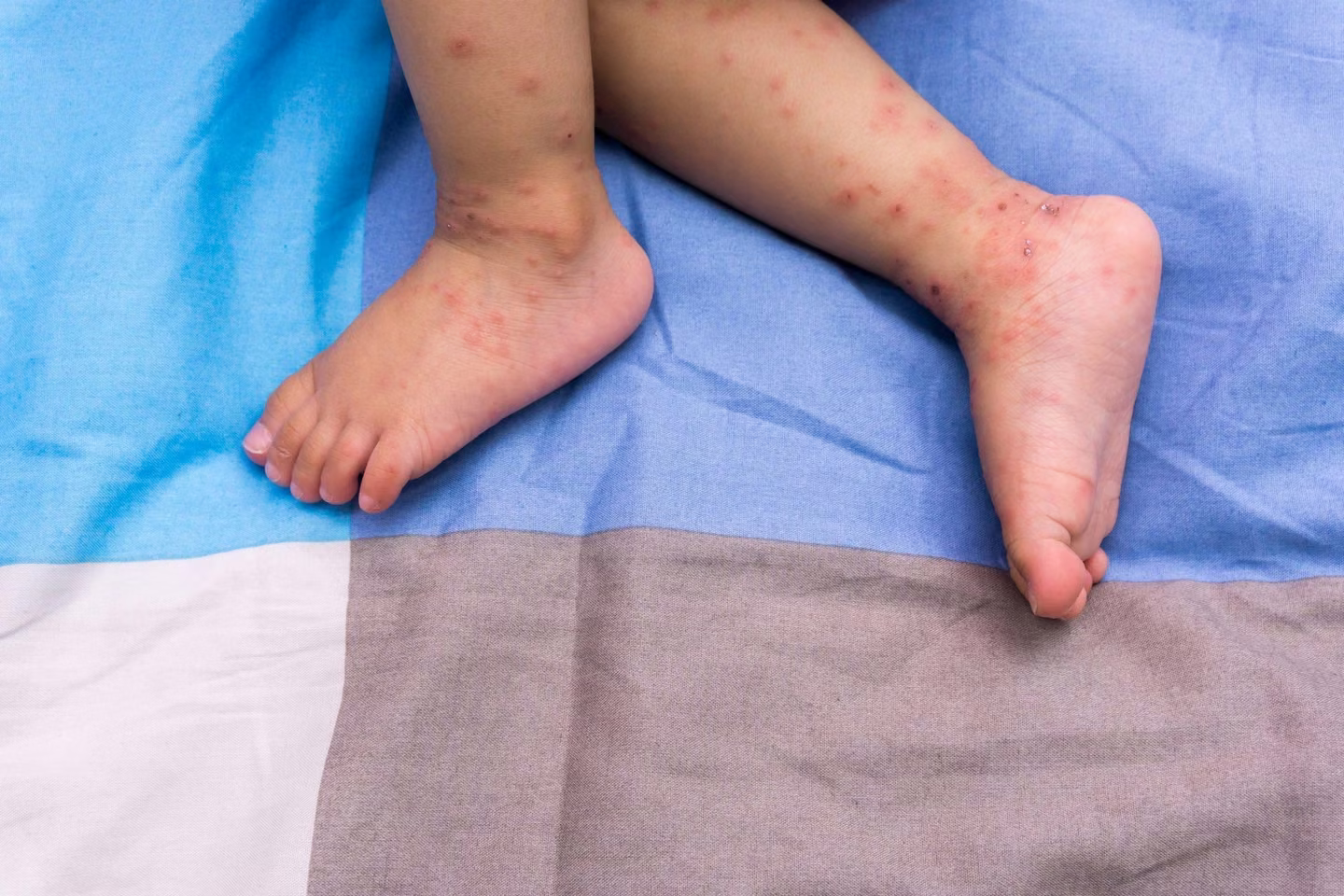A child’s legs showing a rash with red spots, lying on a multicolored blue and gray bedsheet, may need urgent care at a walk-in clinic.