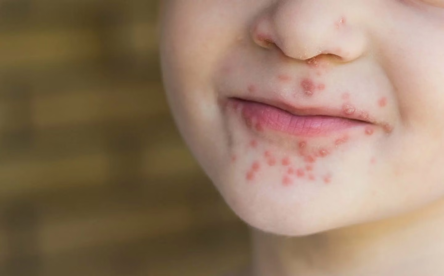 Close-up of a child's face with a rash consisting of red spots around the mouth and on the chin, taken at an urgent care facility against a neutral background.