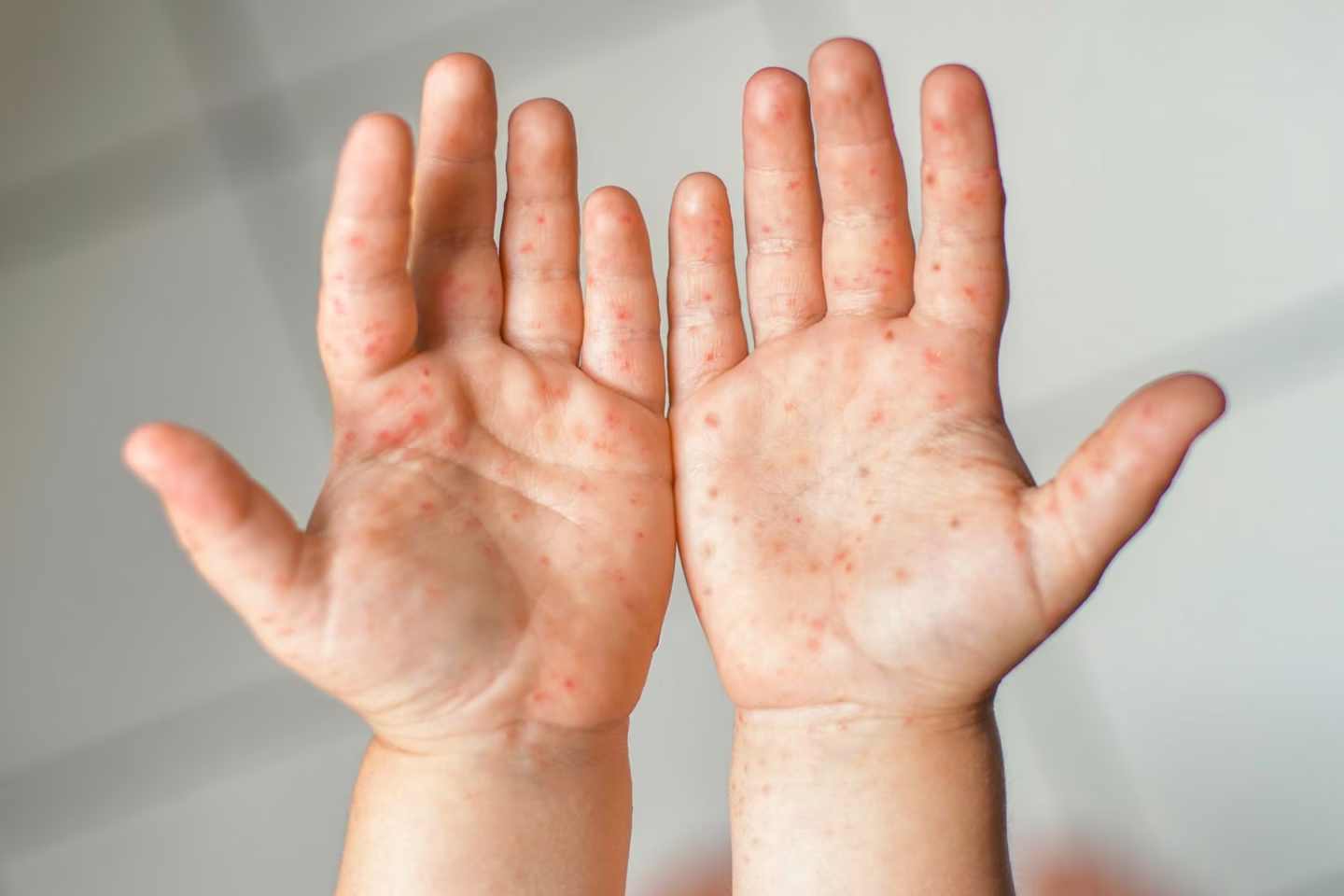 Hands of a person with a rash consisting of small red spots, possibly indicating a skin condition like measles or hand, foot, and mouth disease. The background is blurred, suggesting the image was taken at a medical center during routine physicals or lab testing.