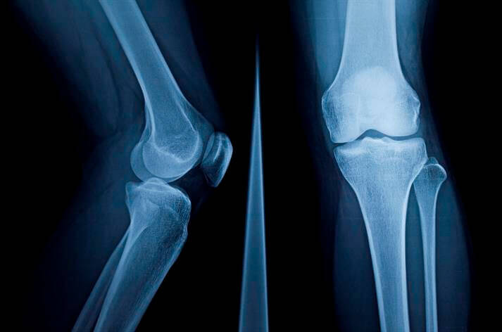 X-ray image showing the side and front view of a human knee joint, highlighting the bones and joint structure, often used in urgent care settings for accurate assessment.