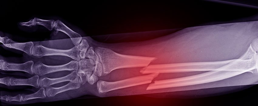 What Should I Know About Fractures?