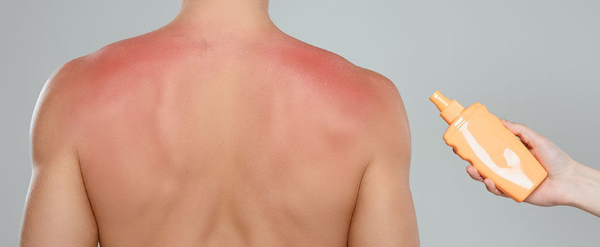 How Can I Avoid Getting Sunburned This Year?