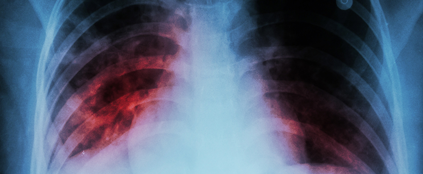 What Exactly Is Pneumonia?