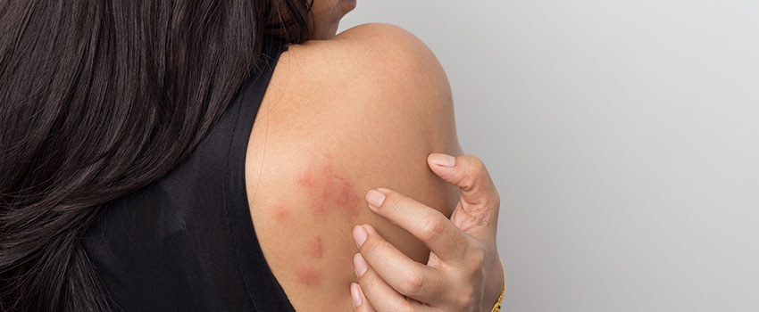 What’s the Difference Between a Poison Ivy Rash and a Poison Oak Rash?
