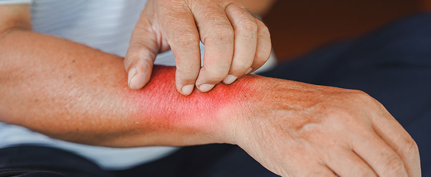 Is Ringworm Treatable?