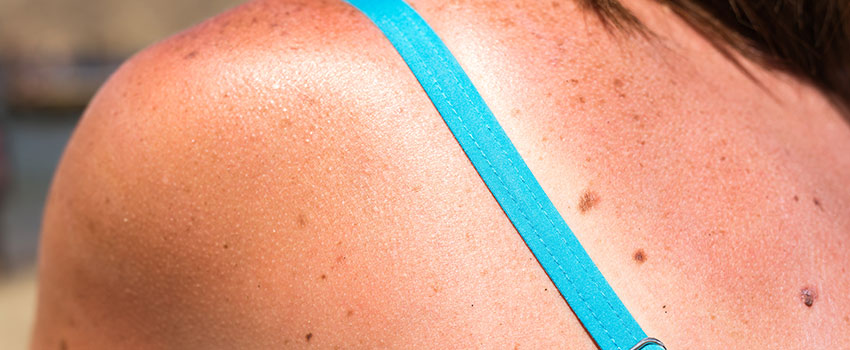 How Can I Prevent Sunburns?