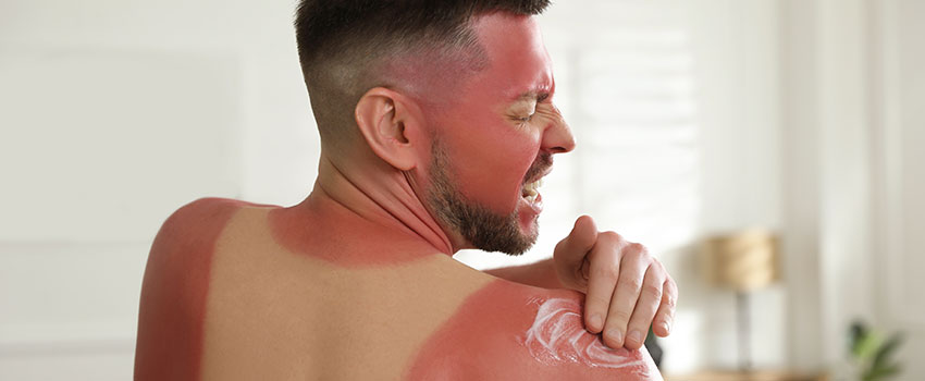 Why Is a Sunburn Bad For You?