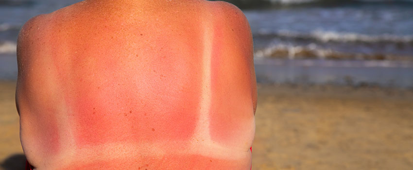 Can I Prevent Getting Sunburned This Summer?