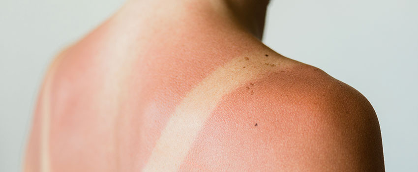 Why Is Sun Exposure Dangerous?