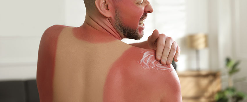 How Fast Will a Sunburn Go Away?