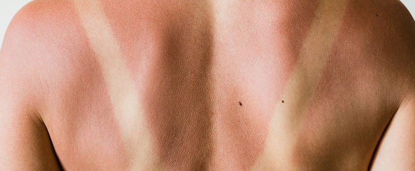 What Are the Stages of a Sunburn?