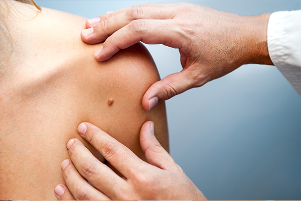 How Does the Sun Affect Your Skin?- AFC Urgent Care