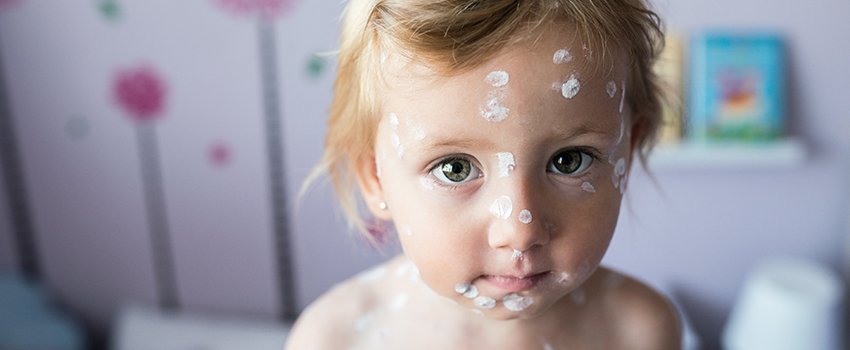 How Do I Know If It's Chickenpox?- AFC Urgent Care