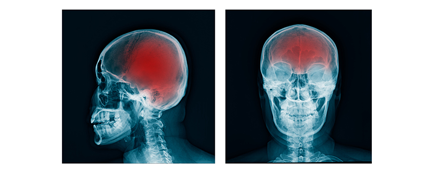 How Can You Protect Yourself From a Traumatic Brain Injury?- AFC Urgent Care
