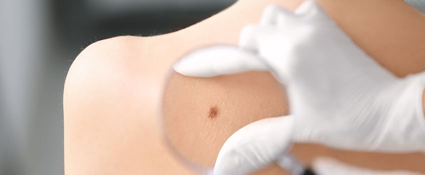 Am I at Risk for Skin Cancer?