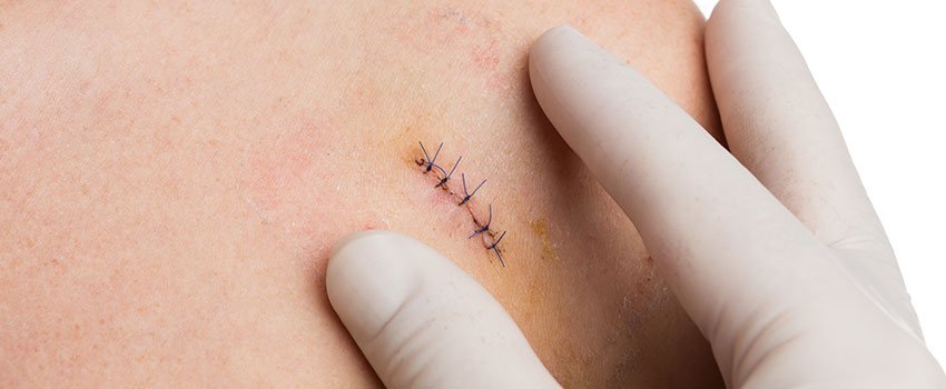 When to Get Stitches- AFC Urgent Care