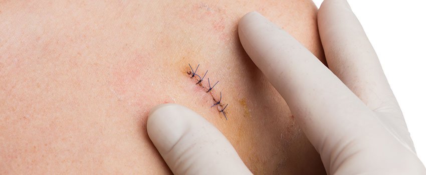 When to Get Stitches