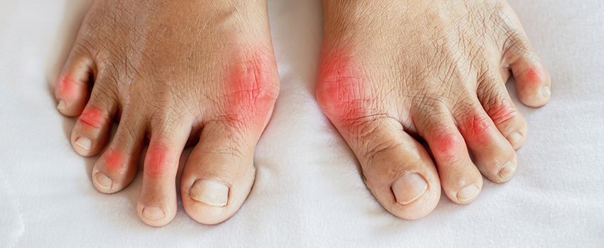 What You Need to Know About Gout- AFC Urgent Care
