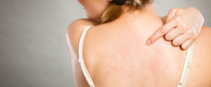 How to Know If You’re Experiencing Heat Rash- AFC Urgent Care