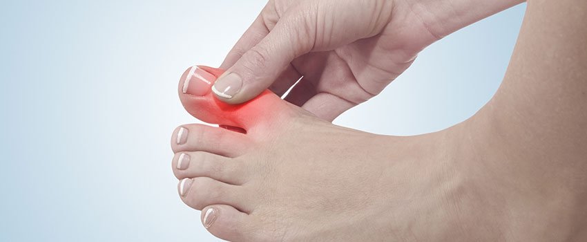 Everything You Need to Know About Gout