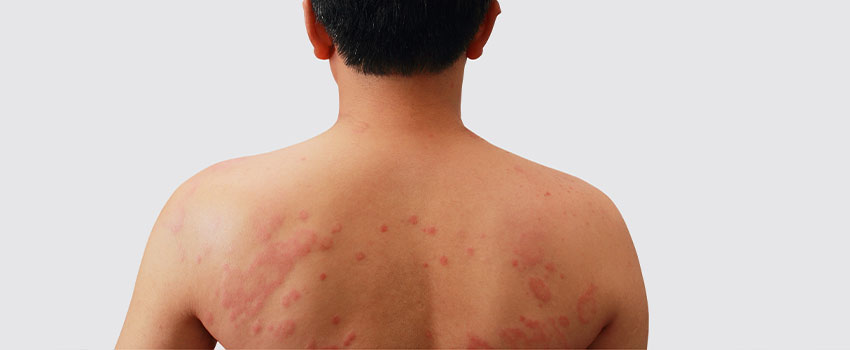 What to Do When You Develop a Rash- AFC Urgent Care