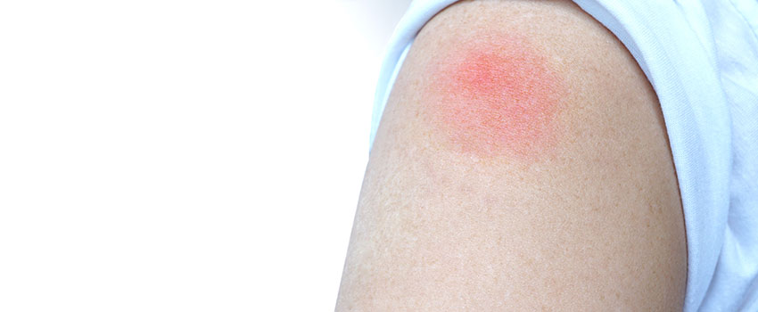 What You Need to Know About Heat Rash- AFC Urgent Care