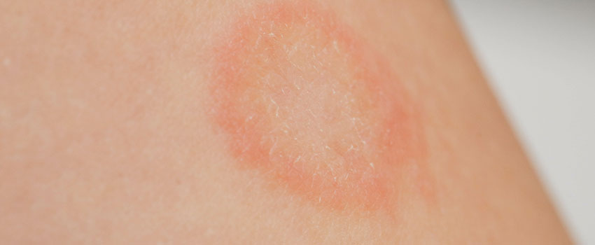 How Would I Know If I Have Ringworm?- AFC Urgent Care