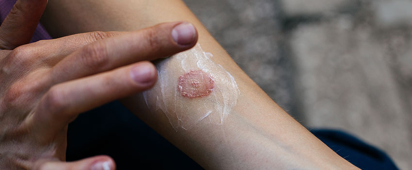 How Bad Is It to Get Ringworm?