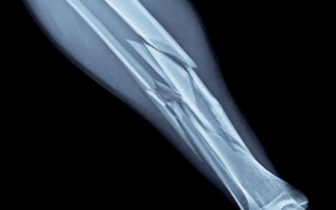 How to Handle a Broken Bone- AFC Urgent Care