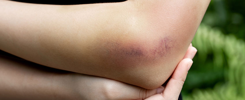 Do Some People Bruise Easier Than Others?- AFC Urgent Care