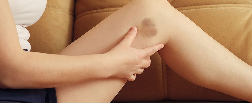 Is There a Reason I Bruise Easily?- AFC Urgent Care