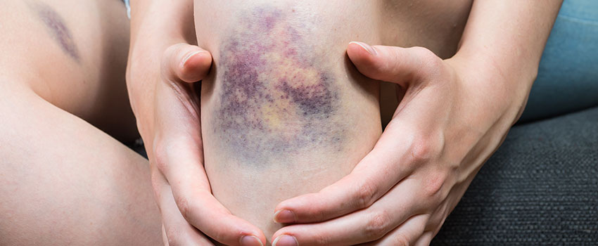 Why Am I Susceptible to Frequent Bruising?