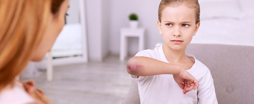 Is There a Reason My Child Bruises Often?- AFC Urgent Care