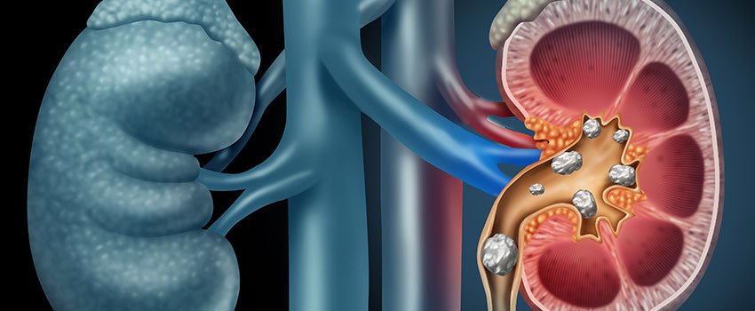 What Symptoms Do Kidney Stones Cause?- AFC Urgent Care