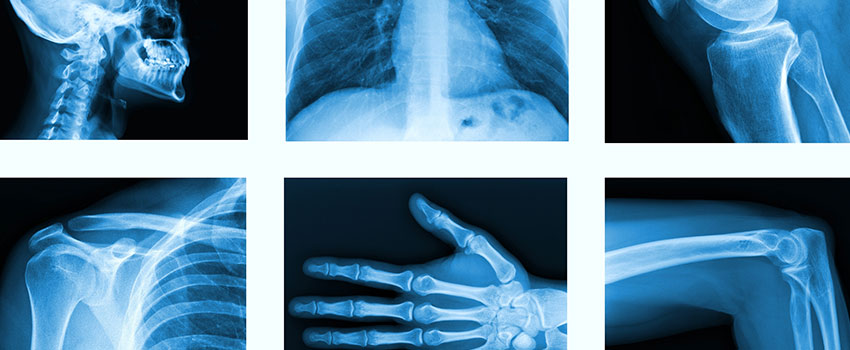 Are All Fractures Severe?- AFC Urgent Care