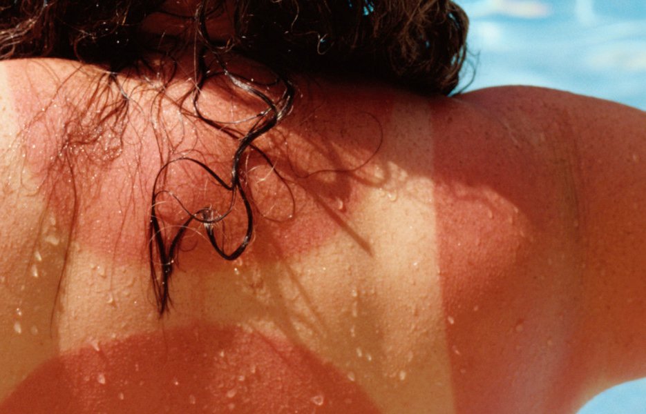 Feeling the (Sun) Burn? | Knoxville, TN Walk-In Clinic- AFC Urgent Care