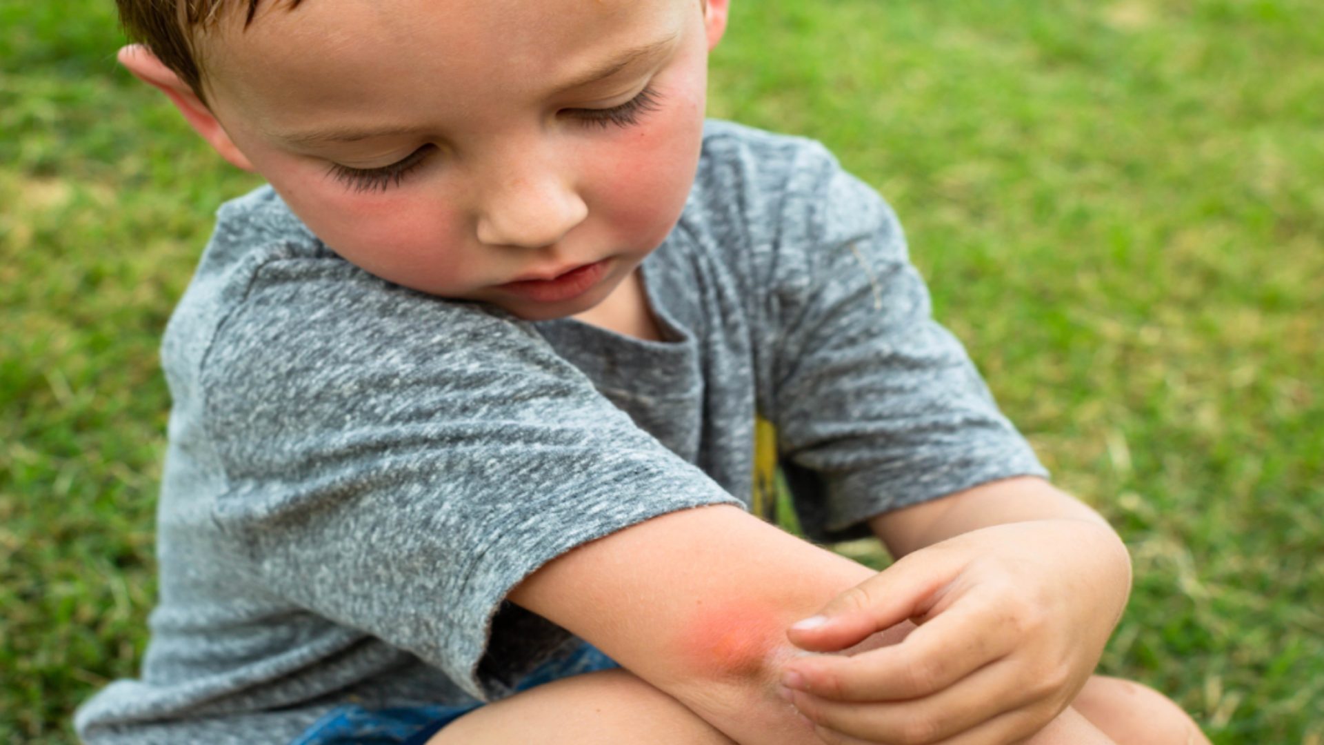 Dealing with Insect Bites and Stings
